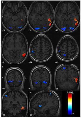 Case Report: Atonic PNES Capture in fMRI